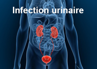 Scanner d'une cystite indiquant l'inflammation