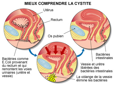 Image montrant comment fonctionne la cystite ?